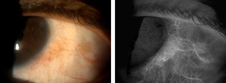 Colour and DVI conjunctival vessel comparison